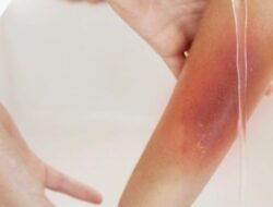 RSUD Pandega Pangandaran Bagikan Tips Pertolongan Pertama Luka Bakar Untuk Masyarakat