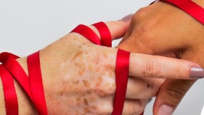 RSUD Pandega Pangandaran Bagikan Informasi: Fakta Penularan HIV/AIDS yang Perlu Diketahui