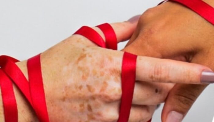 RSUD Pandega Pangandaran Bagikan Informasi: Fakta Penularan HIV/AIDS yang Perlu Diketahui