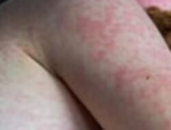 Kasus Campak Meningkat, Satu Penderita Bisa Menularkan Hingga 18 Orang